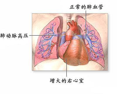 先心病相关肺动脉高压(图)