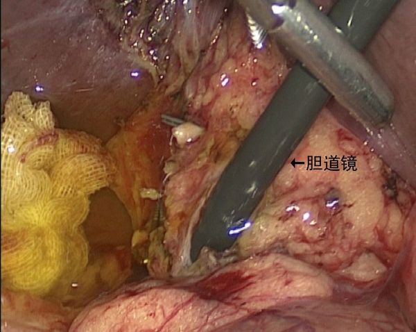 为什么腹腔镜胆囊切除术要全麻?