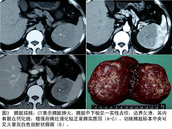 脾脏肿瘤