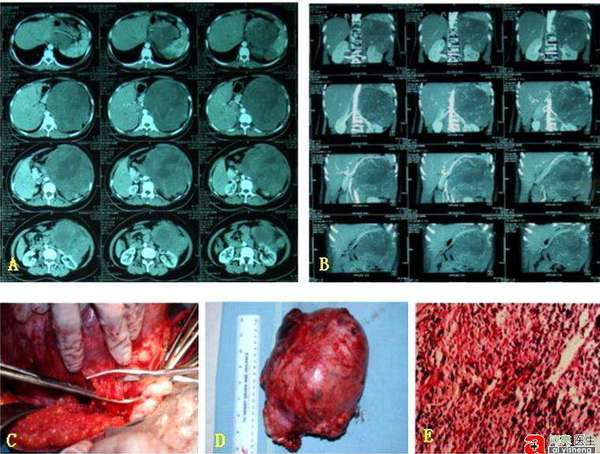 肿瘤外科成功切除一例少见巨大腹膜后节细胞性神经母细胞瘤