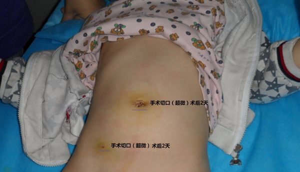 关于疝气有几种手术方法