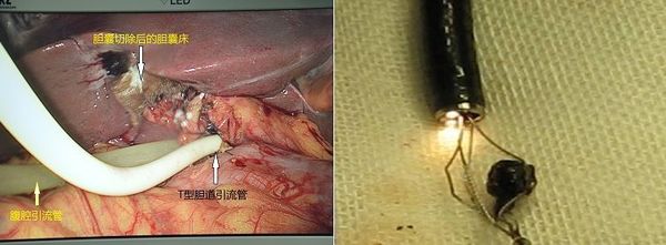 一例腹腔镜下胆总管切开取石,t管引流,胆囊切除术