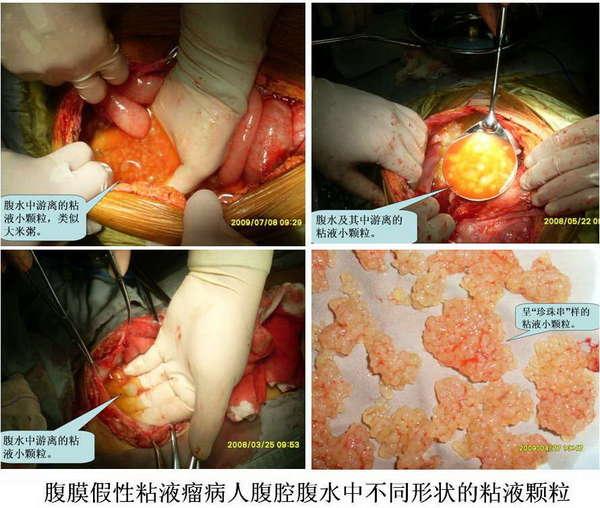 腹膜假性粘液瘤腔镜下及手术中所见