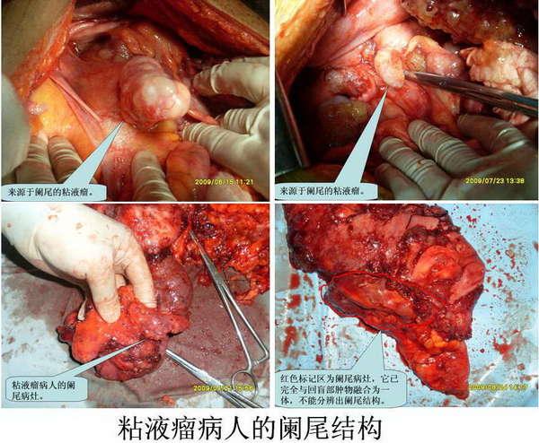 腹膜假性粘液瘤腔镜下及手术中所见