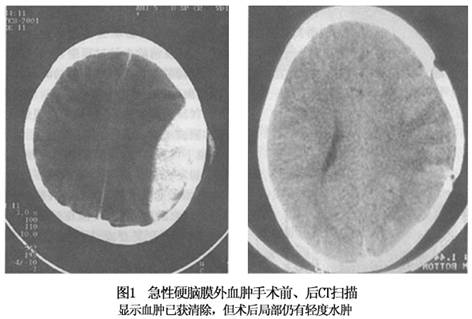 急性硬膜外血肿