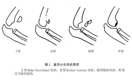 肱骨小头骨折