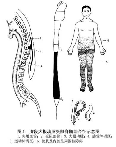 向胸腰段脊髓供血的大根动脉缺血症候群
