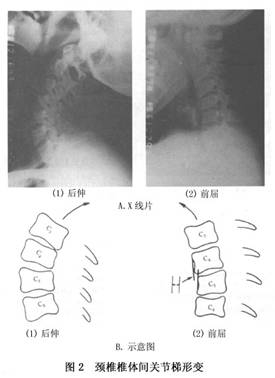 颈椎间盘突出症