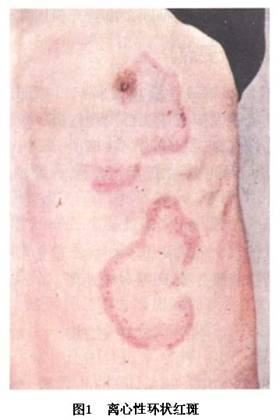 离心性环状红斑(erythema annulase centrifugum)  是一种具有离心性