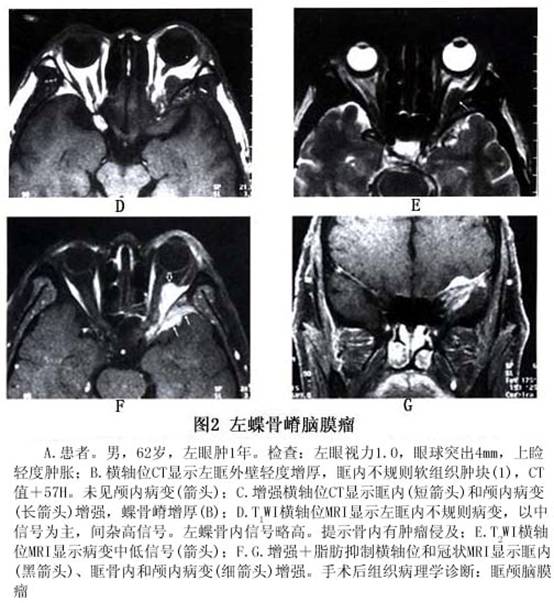 蝶骨嵴脑膜瘤眼部病变