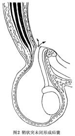 随引带的牵拉及腹腔内压力的传递,睾丸亦随之下降,穿过腹股沟管的内环