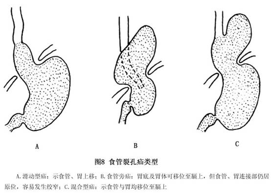 食管裂孔疝