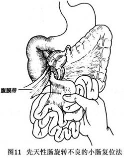 先天性肠旋转不良