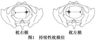 根据胎儿耳廓及耳屏方向判定胎位,耳廓朝向骨盆侧方,诊断为枕横位
