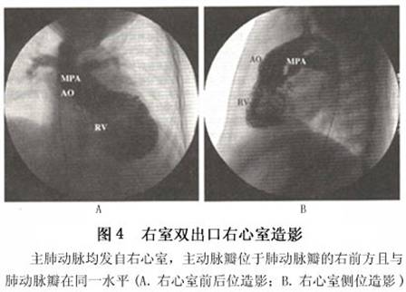 小儿右室双出口