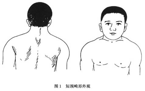 颈椎先天融合畸形