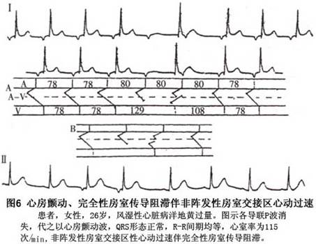 非阵发性交接区性心动过速