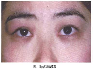 急性泪腺炎(acute dacryoadenitis)并不常见,由于感染或特发性炎症使