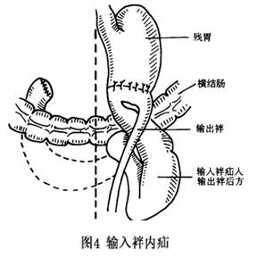 积气积液加重:空肠与treitz韧带以下的空肠肠管上提与残胃小弯侧吻合