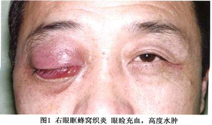 眶蜂窝织炎/眼眶蜂窝织炎/眶蜂窝组织的化脓性炎症-疾病概述-疾病专区
