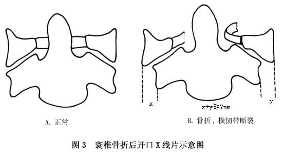 寰椎骨折