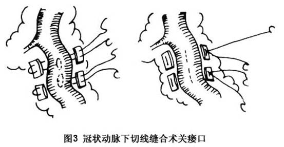 先天性冠状动脉瘘