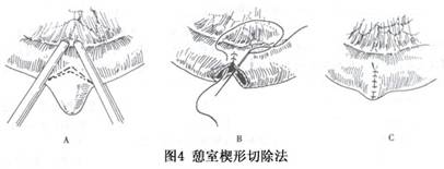 小儿梅克尔憩室