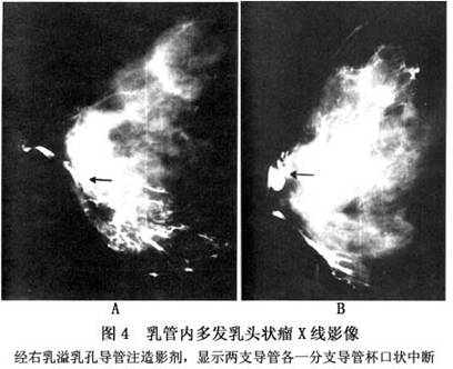 乳房导管内乳头状瘤