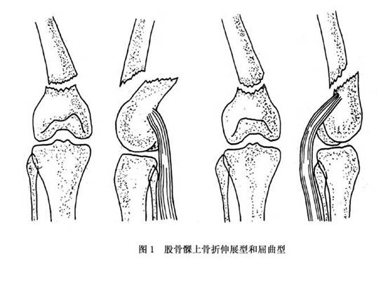 股骨髁上骨折