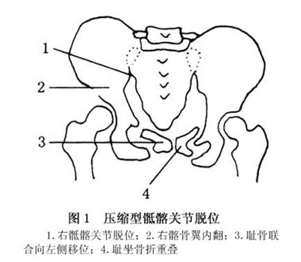 在后环骶髂关节或其邻近发生骨折或脱位,侧方的应力使骨盆向对侧挤压