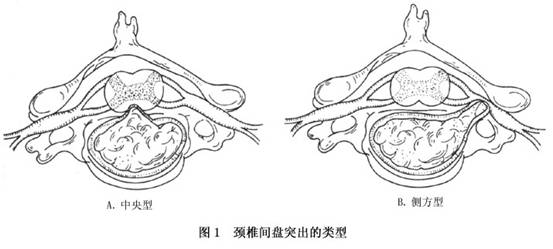 当颈椎间盘中央突出后,因脊髓受压,可出现四肢不完全性或完全性瘫痪