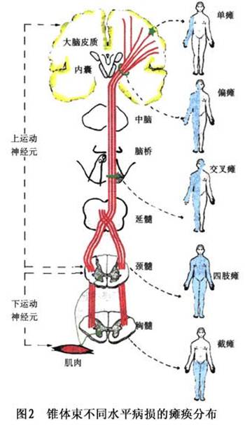 2.上,下运动神经元瘫痪的定位诊断(图2)