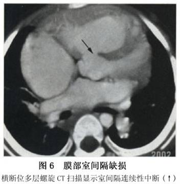 室间隔缺损