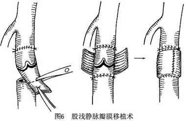 (4)静脉瓣膜移位术:该术式由queral于病症库 y > 原发性下肢静脉机能