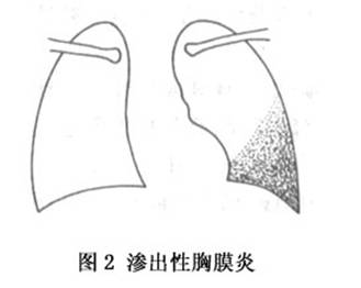 胸腔积液