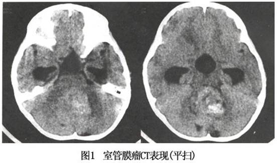 头颅ct与mri对室管膜瘤有诊断价值.