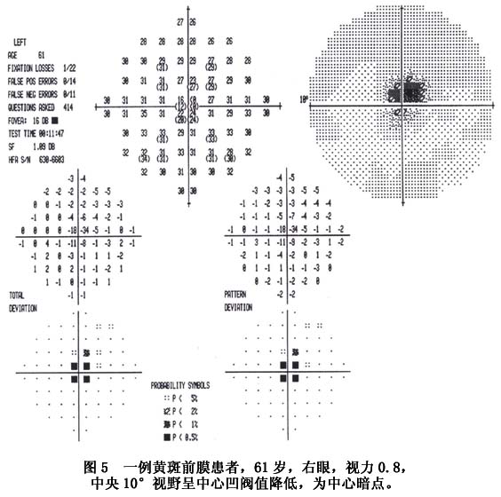 被认为可能与黄斑前膜对视网膜组织的牵拉,造成视锥细胞的排列方向