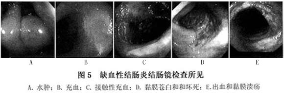 缺血性结肠炎