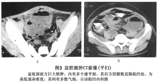 盆腔脓肿