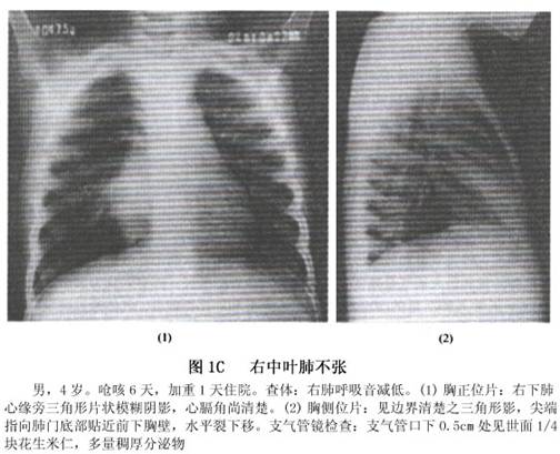 小儿肺不张