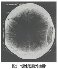 mri  mri诊断慢性硬膜外血肿更具有其特点,尤其是对小而薄的慢性硬膜