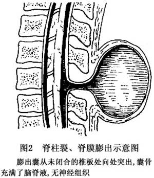 脊膜膨出  在背部中线未闭合的椎板处的软组织内膨出一囊状物,其包囊