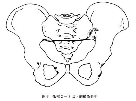 患者多不能站立与行走,髋关节活动受限,骨盆挤压与分离试验阳性