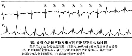 束支折返性室性心动过速详情