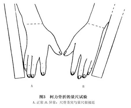 直尺试验  正常时,将直尺放于腕尺侧,尺骨茎突距直尺在1cm以上,桡骨