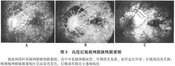 变性近视的脉络膜萎缩