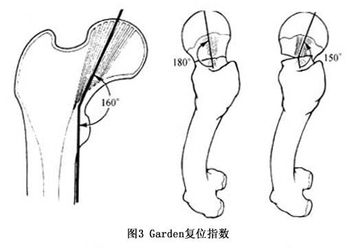 ③骨折移位程度分型(garden分型):garden根据骨折移位程度,将股骨