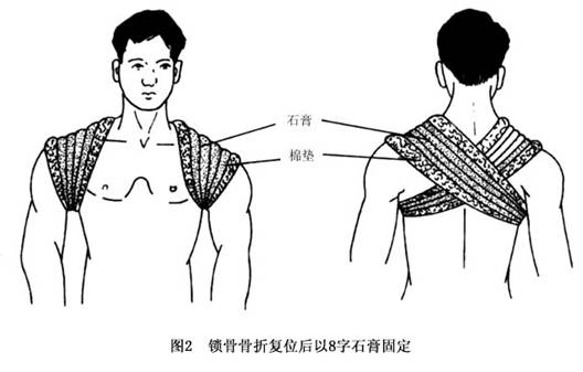 骨折图高清