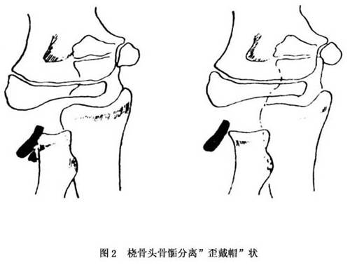 桡骨颈骨折和桡骨头骨骺分离