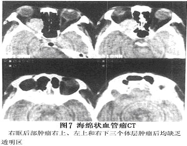 眼眶内海绵状血管瘤
